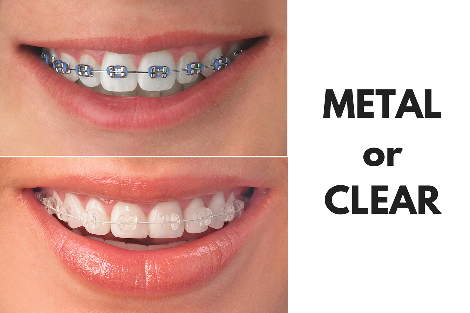 Ask Your Beaumont, Galveston and Port Arthur Dentist: Should I Get Metal or Clear Braces?