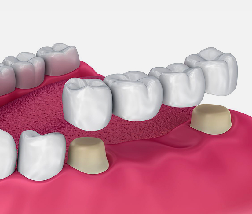 3D dental illustration showing tooth crown restoration procedure with model teeth and gum tissue.