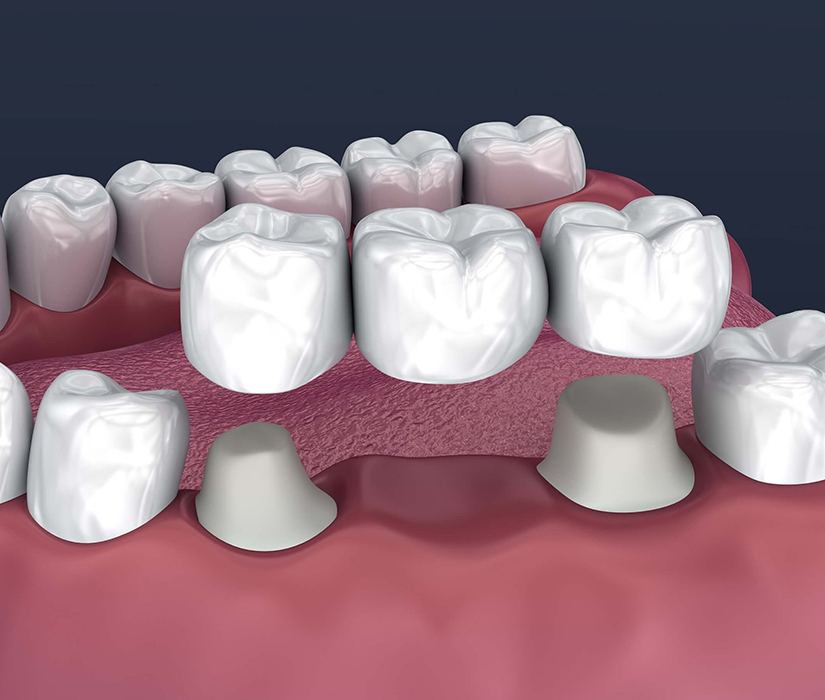 3D dental model showing tooth restoration with crowns and implants on gum tissue.