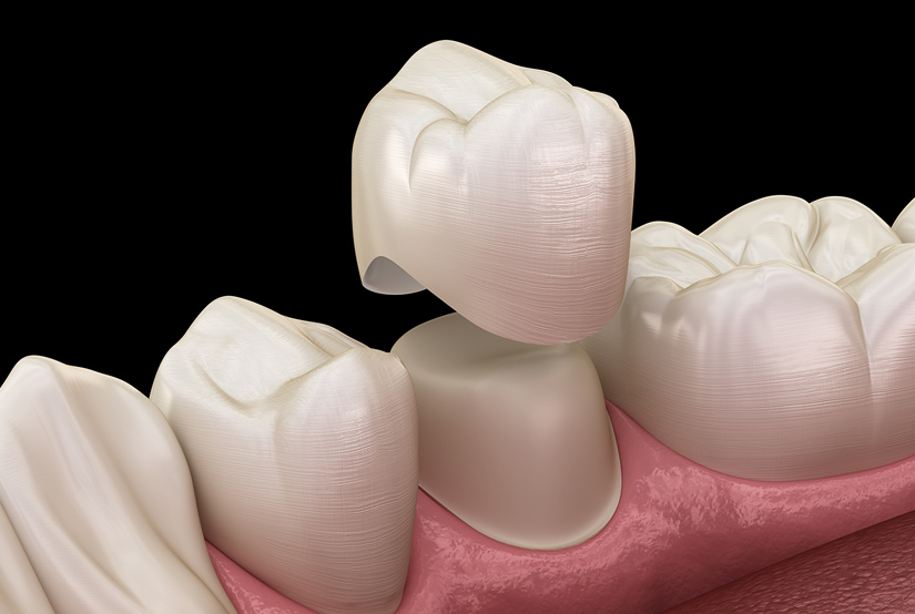 Dental crown placement illustration showing tooth restoration on gum model with natural tooth comparison.