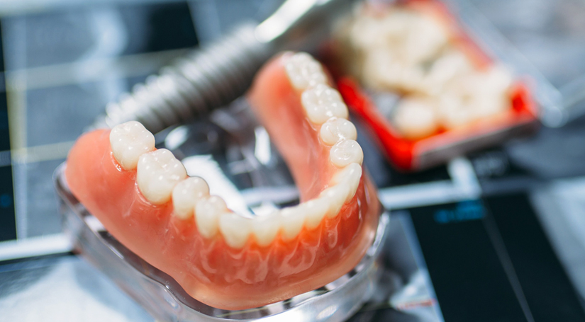 Dental model showing orthodontic braces on upper and lower teeth in clinical setting.