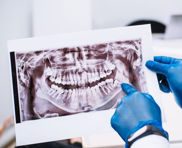 Dentist in blue gloves examining dental X-ray of teeth and jaw structure in clinical setting.